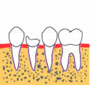 歯牙再植-1