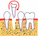 歯牙再植-2