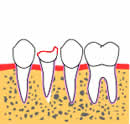 歯牙移植-3